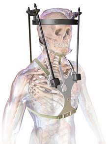 Why You Should Consider: Spinal Orthoses – Human Technology Prosthetics and  Orthotics