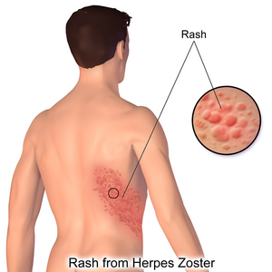 Herpes Zoster Rash