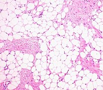 Histopathology of a lipoma: The mass is composed of lobules of mature white adipose tissue divided by fibrous septa containing thin-walled capillary-sized vessels.[25][predatory publisher] H&E stain.