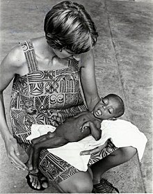 Marian Cast, nutricionista de IVS, con un niño desnutrido en Papua Nueva Guinea, 1978