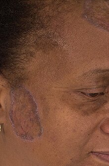 Фиолетовые, кольцевидные, чешуйчатые бляшки на лице и волосистой части головы взрослого человека