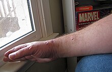 Bite wounds inflicted by a pet blue-and-yellow macaw Macaw bite.jpg