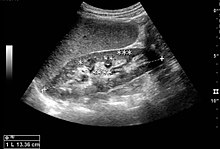 Figure 1. Normal adult kidney. Measurement of kidney length on the US image is illustrated by '+' and a dashed line. *Column of Bertin; ** pyramid; *** cortex; **** sinus. Normal adult kidney.jpg
