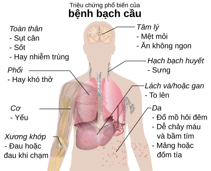 File:Symptoms of leukemia-vi.svg