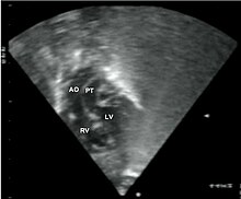 Subcostal echocardiographic view showing discordant ventriculoarterial connections together with the presence of parallel, rather than crossing, great arteries arising from the ventricles. Transposition great arteries Orphanet 1750-1172-3-27-2.JPEG