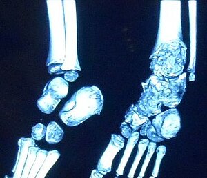 3D CT image of Trevor's disease of the ankle and talus. Trevor's disease of ankle and talus ..JPG
