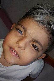 <span class="mw-page-title-main">Waardenburg Syndrome Type 1</span> Congenital disorder