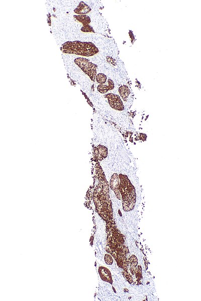 File:ALK positive lung adenocarcinoma - ALK IHC -- very low mag.jpg