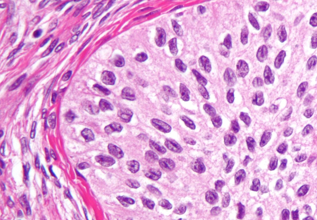 Surface epithelial-stromal tumor