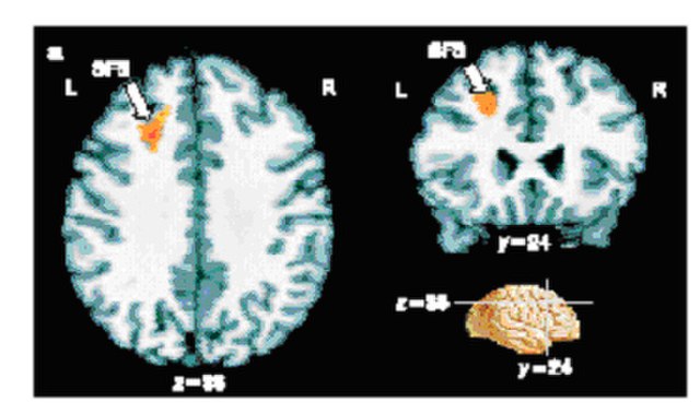 Results from an fMRI experiment in which people made a conscious decision about a visual stimulus. The small region of the brain coloured orange shows