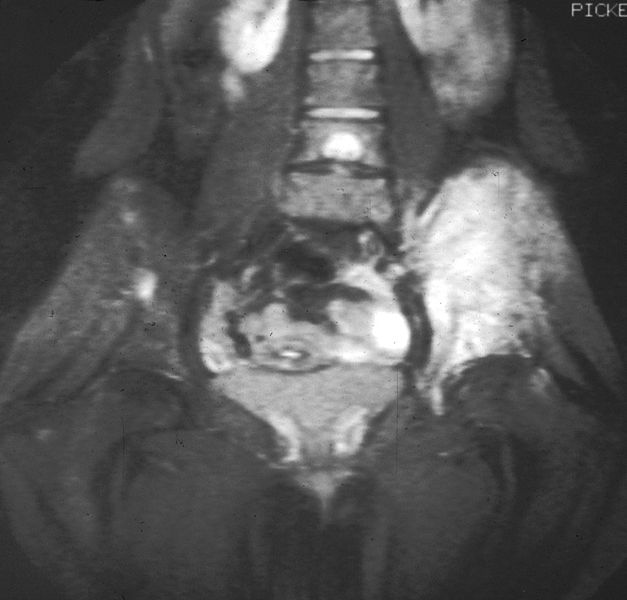 File:Ewing's sarcoma MRI nci-vol-1832-300.jpg