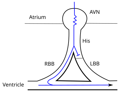 File:Fixed LBBB (CardioNetworks ECGpedia).svg