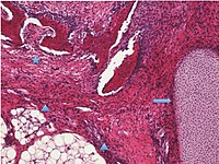 Histopatología del teratoma inmaduro de ovario.jpg