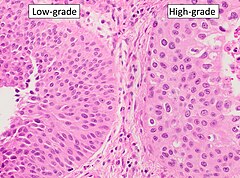 Transitional cell carcinoma, being low-grade to the left, and high-grade to the right. H&E stain