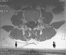 Fig. 11. Slice-to-slice interference (T1 axial study of lumbar vertebrae). MRI with slice-to-slice interference.jpg