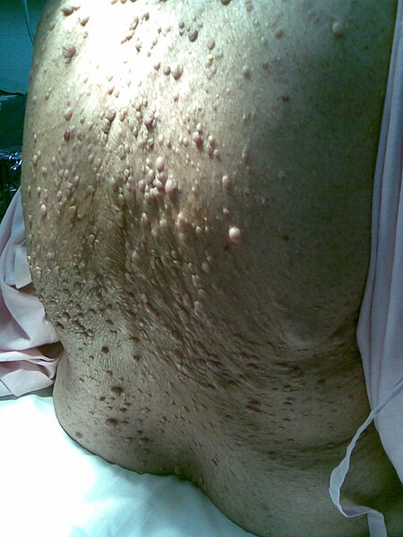 File:Neurofibromatosis.jpg