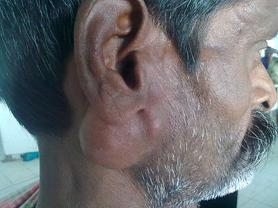 Salivary gland tumour