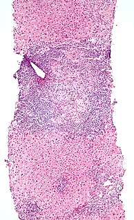 Intraepithelial lymphocyte