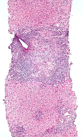 <span class="mw-page-title-main">Intraepithelial lymphocyte</span>
