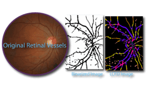 Figure 3. Retinal vasculature revealed through box counting analysis; colour-coded local connected fractal dimension analysis done with FracLac freeware for biological image analysis. Retina lcfd.gif