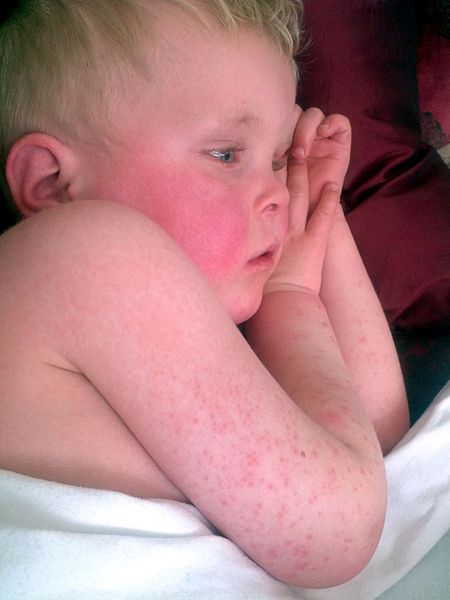 File:Scarlet Fever.jpg