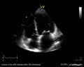 Файл: тяжелый стеноз митрального клапана, митральная регургитация, аортальная регургитация E00621 (CardioNetworks ECHOpedia) .webm