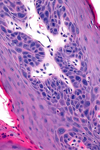 File:Squamous papilloma -- high mag.jpg