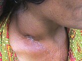 A person's neck is shown. At the base of the neck is a dark colored depression in the skin, around which the neck is heavily inflamed. The skin at the base of the neck and the top of the chest is rashed and discolored.