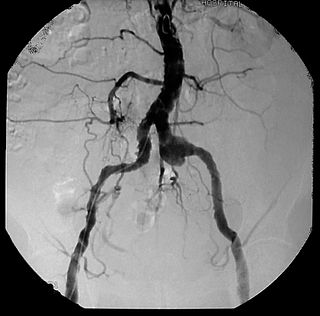 Syphilitic aortitis Inflammation of the aorta