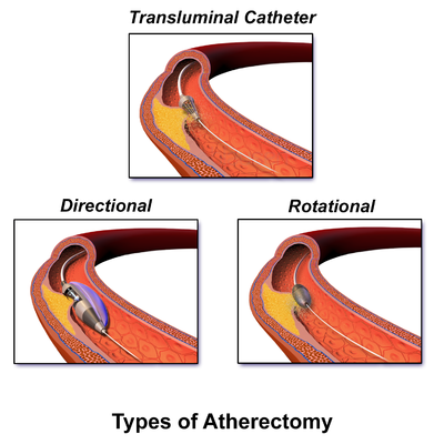 3 types body Wikipedia  Atherectomy