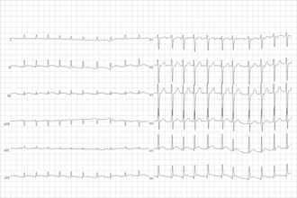 This ECG from the same patient shows atrial fibrillation at around 126 beats per minute. Brady-tachy syndrome atrial fibrillation.png