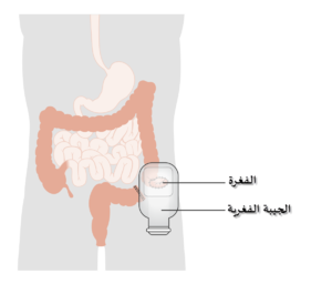 Diagram showing a colostomy with a bag CRUK 061-ar.png