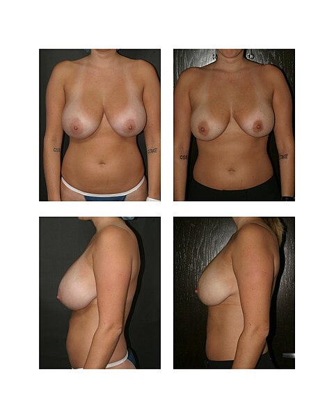 File:Dr. Placik Breast reduction.jpg