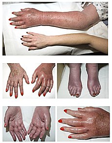 Erythromelalgia.jpg