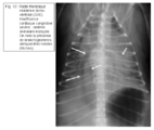 Figure 10 : Radio thoracique incidence dorso-ventrale (CKC). Insuffisance cardiaque congestive sévère : œdème alvéolaire marquée. On note la présence de bronchogrammes aériques très visibles (flèches).