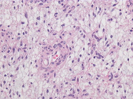 Fail:Neuropathology_case_V_03.jpg