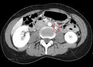 CT showing dilatation and thrombosis of the left renal vein in a patient with nutcracker syndrome NutCracker2.PNG