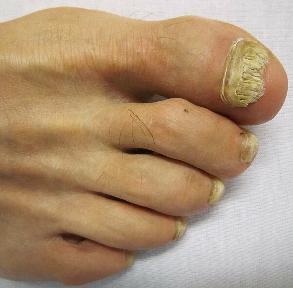 A toenail affected by onychomycosis