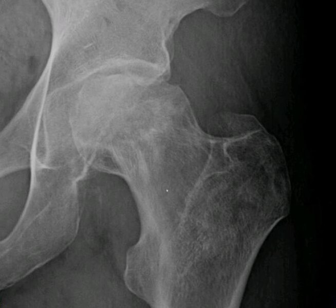 File:Osteonecrosis femur 1.jpg