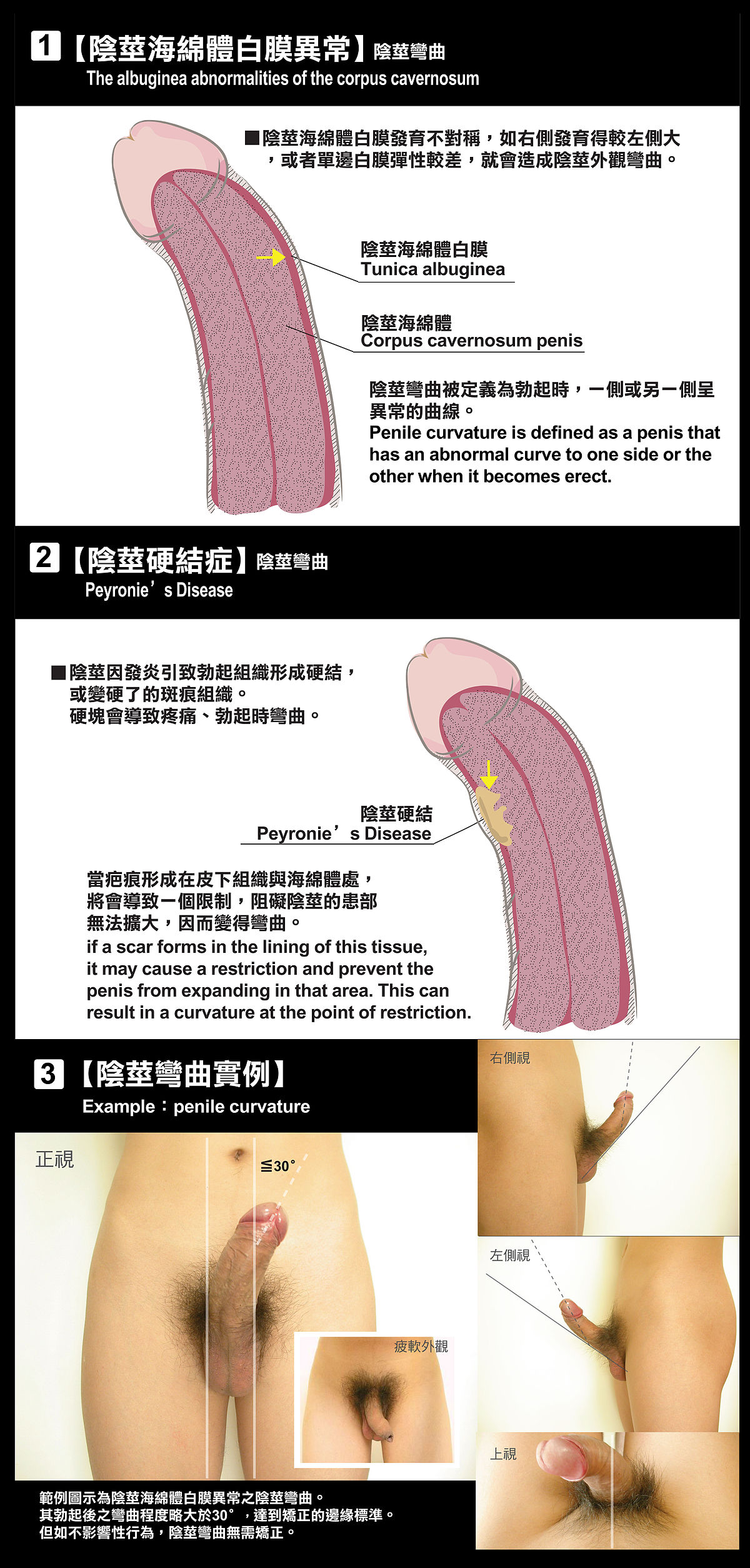 陰莖彎曲 维基百科 自由的百科全书