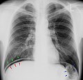 Pneumoperitoneum im Thoraxröntgenbild. Die freie "Luft" ist zwischen dem Oberrand der Leber (rote Pfeile) und dem Zwerchfell (grüne Pfeile) zu erkennen. Die blauen Pfeile zeigen auf den gasgefüllten Dickdarm (normal).