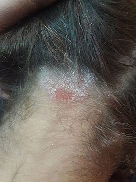 Pitriasis amintaceus nueva foto para buen diagnostico,tipo de eczema,infiltracion de escamas.jpg