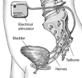 Thumbnail for Sacral nerve stimulator