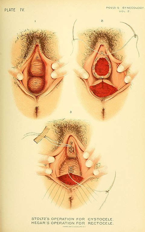 https://upload.wikimedia.org/wikipedia/commons/thumb/a/a4/Treatise_on_gynaecology_-_medical_and_surgical_%281894%29_%2814780462352%29.jpg/480px-Treatise_on_gynaecology_-_medical_and_surgical_%281894%29_%2814780462352%29.jpg