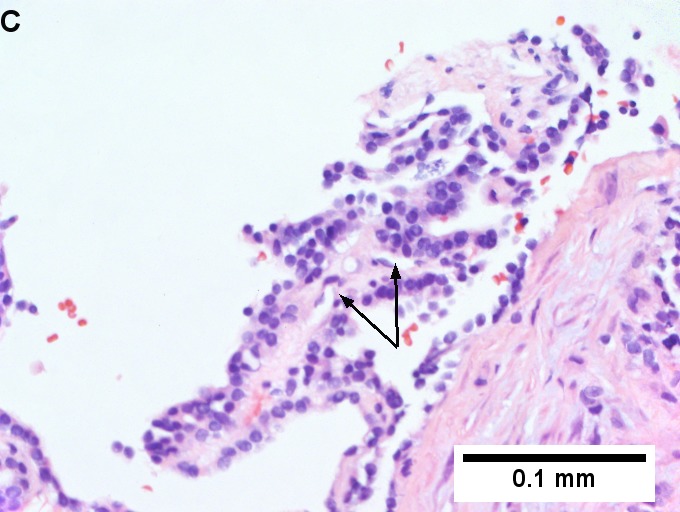 File:3 thyroid met 1 680x512px.tif