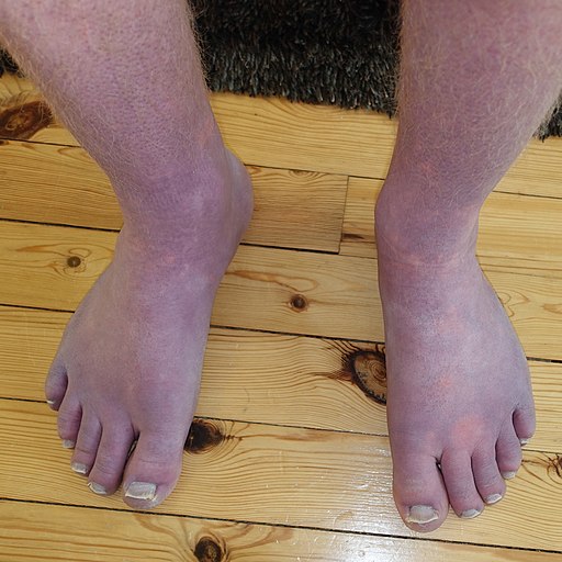 An example of acrocyanosis caused by POTS.