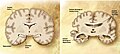 Et diagram over en normal hjerne (venstre) og en Alzheimer-patients hjerne (højre)