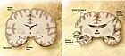 Diagram of a normal brain (left) and an Alzheimer's patient brain (right)