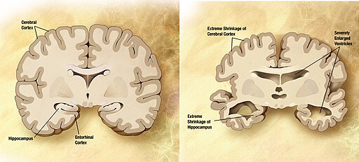 Alzheimer's disease brain comparison. Public domain.