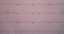 An ECG in a person with a single-chamber pacemaker to the atrium. Note the circle around one of the sharp electrical spikes in the position where the P wave would be expected. AtrialPacemakerECG.JPG